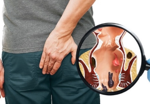 Áp xe hậu môn do đâu mà có?